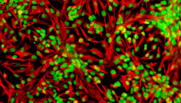 Immagine al microscopio di cellule staminali neurali umane, marcate per la proteina Sox2 (in verde, contenuta all'interno del nucleo) e la proteina vimentina (in rosso, proteina strutturale del corpo della cellula)