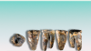 denti di neanderthal